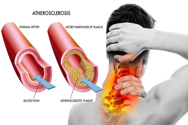 Body signs and symptoms of increased cholesterol and treatment in hindi:  दिखें ये संकेत तो समझ लें कि बढ़ गया है आपका कोलेस्ट्रॉल, इतना लेवल होता है  नार्मल - India TV Hindi