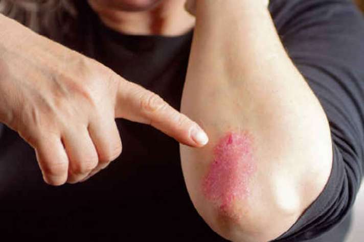 World psoriasis day skin disease precautions and symptoms in hindi - India  TV Hindi News