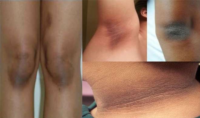 Home Remedies To Get Rid Of Black Knees And Elbow: कोहनी और घुटनों के  कालेपन को इस तरह से करें दूर, तुरंत दिखेगा फायदा - India TV Hindi News