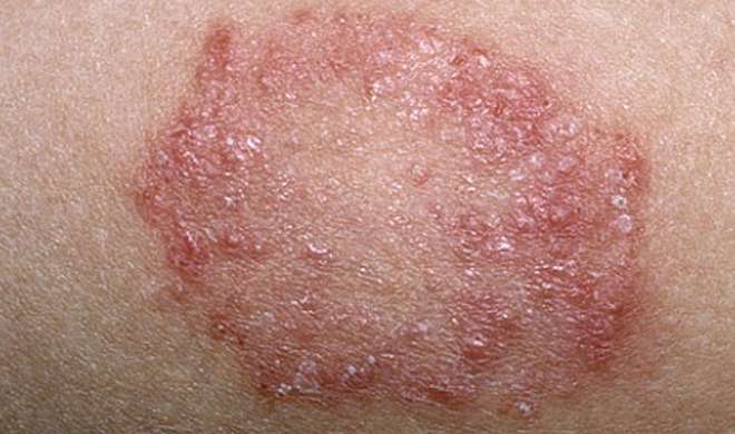 Fungal Skin Infections Common Treatment & Care: फंगल इंफेक्शन से चाहिए  हमेशा के लिए निजात तो 'जैतून तेल' का इस तरह से करें इस्तेमाल - India TV  Hindi News