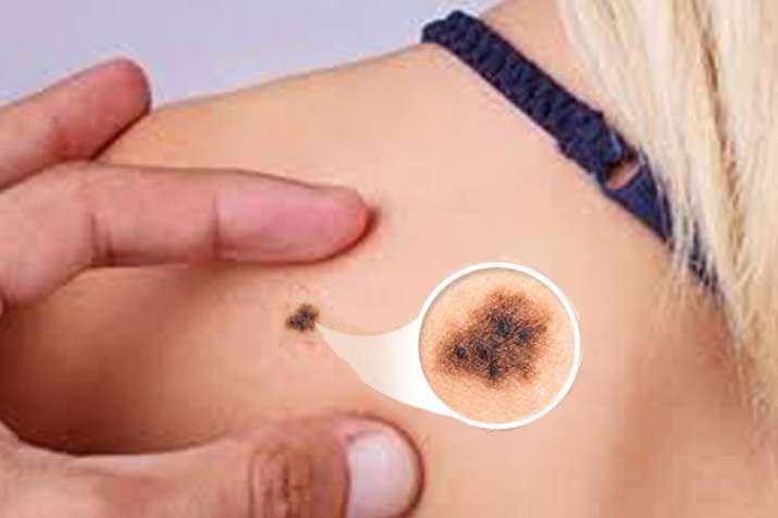 Skin Cancer Skin Cancer- India TV