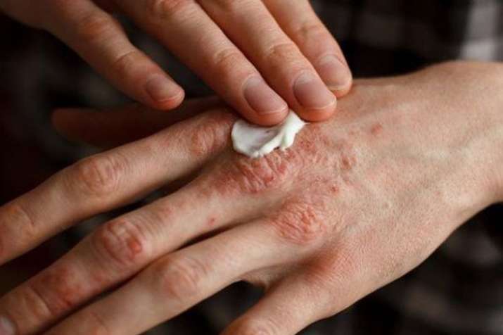 world psoriasis day world psoriasis day- India TV Hindi