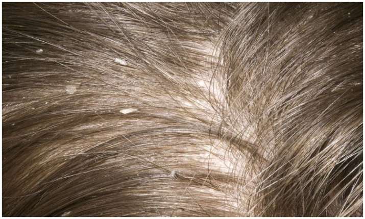 dandruff dandruff- India TV