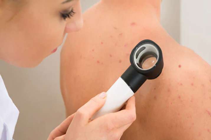 Skin Ellergy Having Skin Ellergy Skin Ellergy Having Skin Ellergy- India TV
