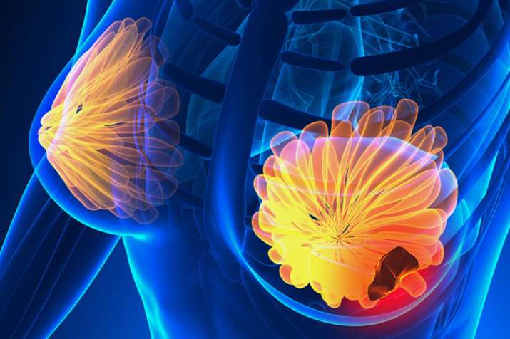 Breast Cancer Breast Cancer- India TV Hindi