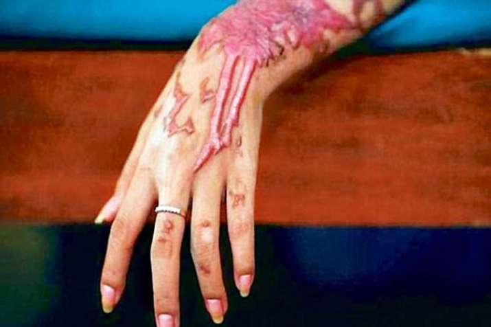 Acid Attack Acid Attack- India TV Hindi