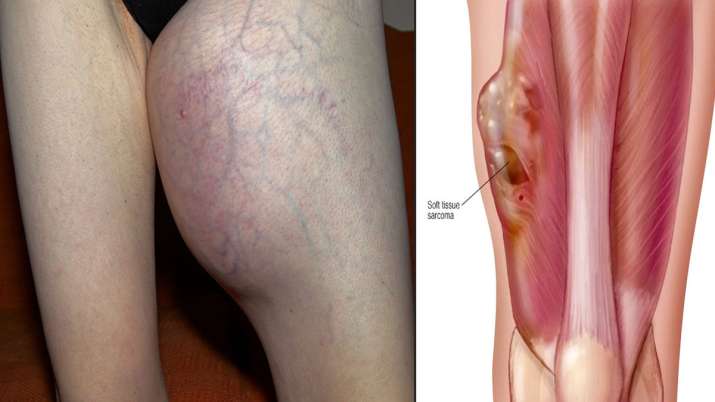 Soft Tissue Sarcoma Soft Tissue Sarcoma- India TV