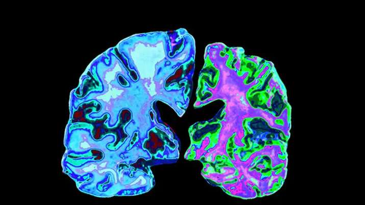 World Alzheimer Day 2019 World Alzheimer Day 2019- India TV