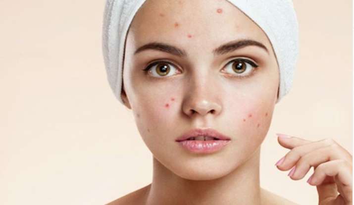 Pimple Home Remedies: मुंहासों से घबराने की जरूरत नहीं, ये टिप्स देंगे चांद सा बेदाग चेहरा Pimple Home Remedies: मुंहासों से घबराने की जरूरत नहीं, ये टिप्स देंगे चांद सा बेदाग चेहरा- India TV Hindi