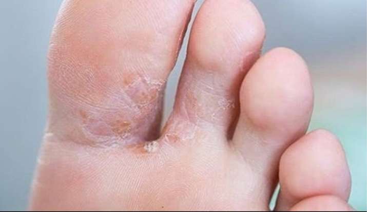 Home Remedies For Get Rid Fungal Infection In Foot After Rain In Hindi ब र श क प न क क रण प र म ह गय ह फ गल इ फ क शन त अपन ए य घर ल उप य India