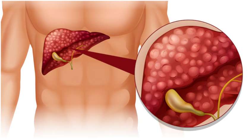 Apakah Anda merasakan nyeri pada area liver? Jika ya, kemungkinan besar liver Anda telah rusak. Selain itu, sebagai informasi, izinkan kami memberi tahu Anda bahwa rasa terbakar atau rasa berat di dada juga bisa menjadi tanda memburuknya kesehatan hati.