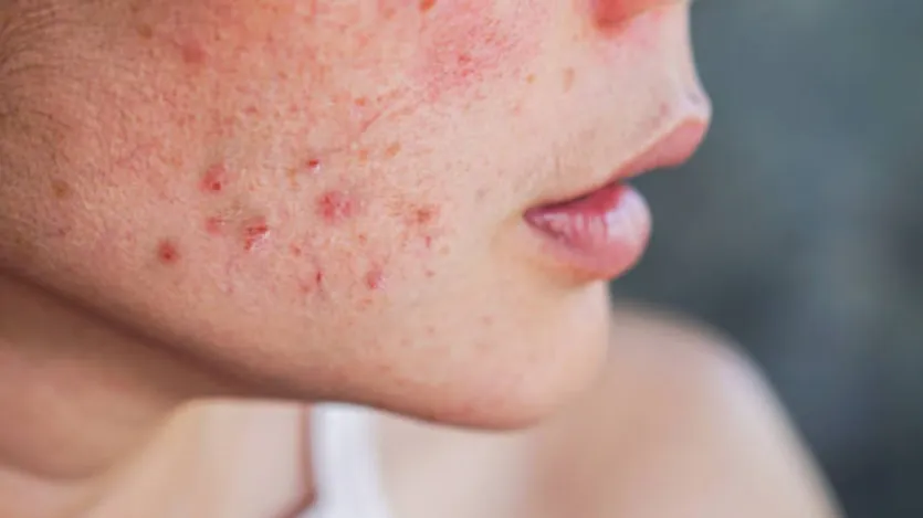 As propriedades anti-sépticas e anti-inflamatórias presentes em bicarbonato de sódio são benéficas na remoção da pele da pele. Também reduz a vermelhidão e a inflamação da acne. O bicarbonato de sódio limpa a pele morta e fornece uma cor brilhante. Faça uma pasta misturando 1 colher de chá de bicarbonato de sódio 1 colher de chá de planície. Molhe o rosto e aplique -o em espinhas e outras áreas afetadas. Deixe por três minutos e lave o rosto com água morna. Em seguida, lave -o com água fria e deixe secar. As propriedades anti-sépticas e anti-inflamatórias presentes em bicarbonato de sódio são benéficas na remoção da pele da pele. Também reduz a vermelhidão e a inflamação da acne. O bicarbonato de sódio limpa a pele morta e fornece uma cor brilhante. Faça uma pasta misturando 1 colher de chá de bicarbonato de sódio 1 colher de chá de planície. Molhe o rosto e aplique -o em espinhas e outras áreas afetadas. Deixe por três minutos e lave o rosto com água morna. Em seguida, lave -o com água fria e deixe secar.