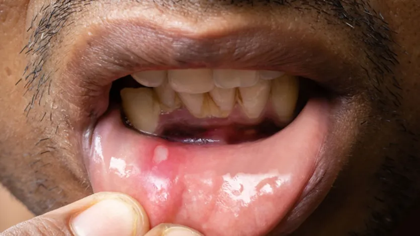 Se houver bolhas na boca, fica difícil comer e beber qualquer coisa. Embora as bolhas sejam muito pequenas, elas também são muito dolorosas. Devido a úlceras, há sensação de queimação na boca por vários dias. De fato, estes são causados ​​por um tipo de vírus infeccioso chamado 'vírus herpes simplex'.