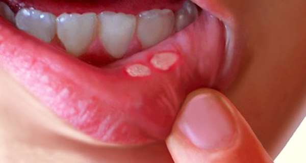mouth ulcer mouth ulcer- India TV Hindi