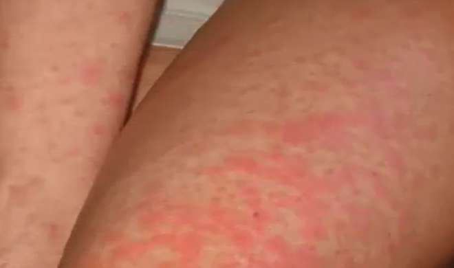 skin skin- India TV Hindi