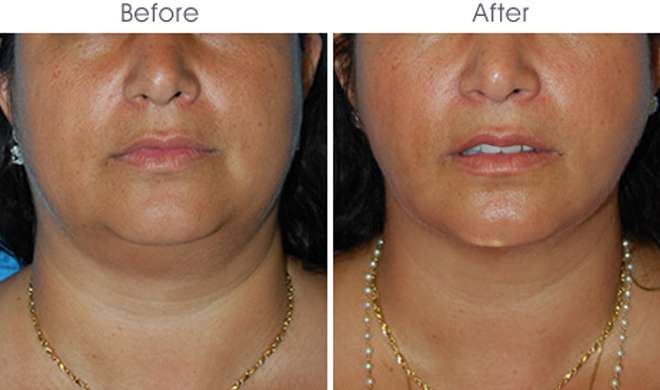 Facial Fat Facial Fat- India TV Hindi