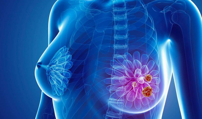 Breast cancer Breast cancer- India TV Hindi