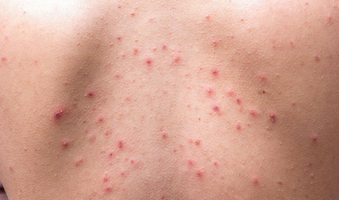 skin problem skin problem- India TV Hindi