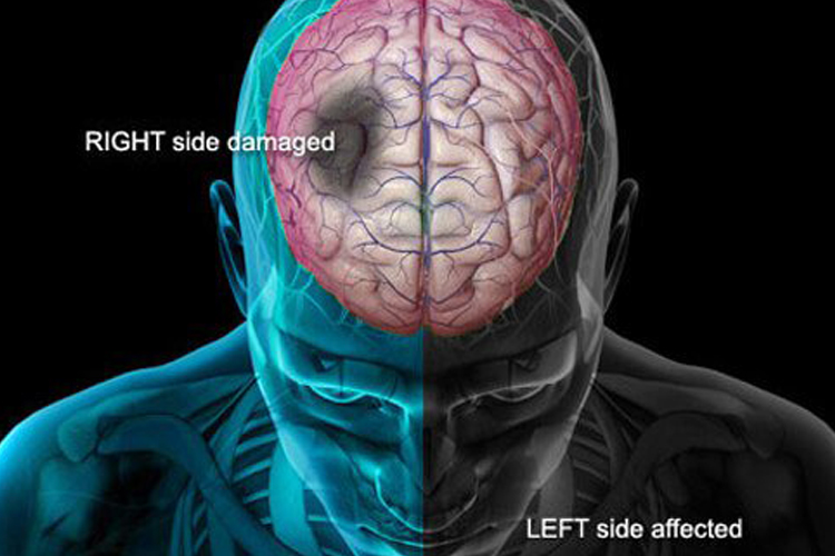 brain stroke
brain stroke
- India TV Hindi