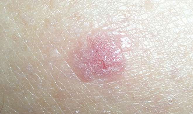 skin cancer skin cancer- India TV Hindi