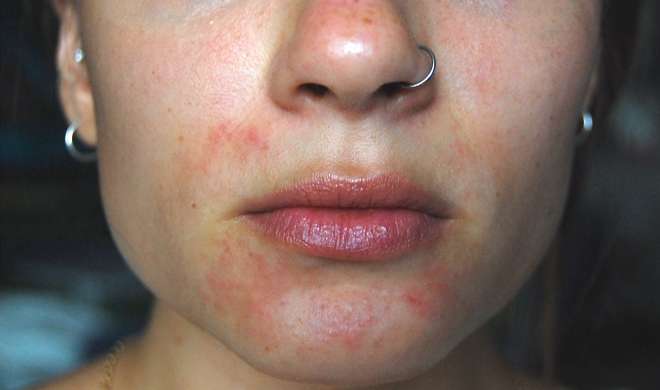 skin problem skin problem- India TV Hindi