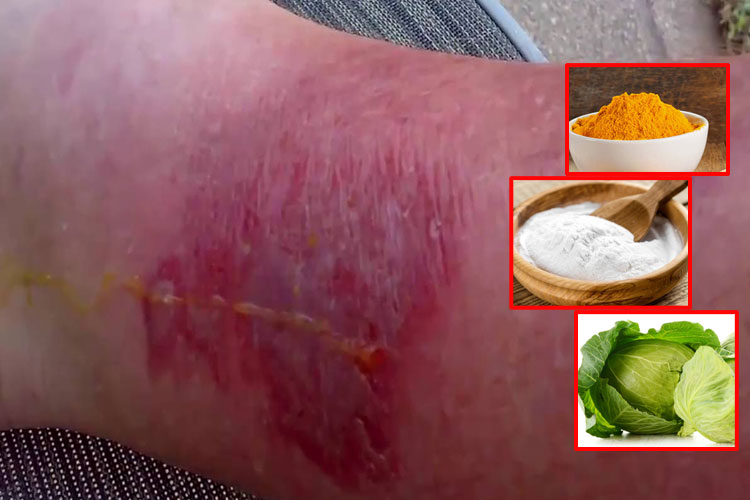 Effective Home Remedies for Spider Bites in hindi Effective Home Remedies for Spider Bites in hindi- India TV Hindi