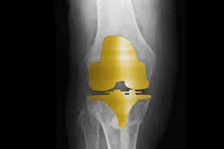 Golden Knee Implant Golden Knee Implant- India TV Hindi