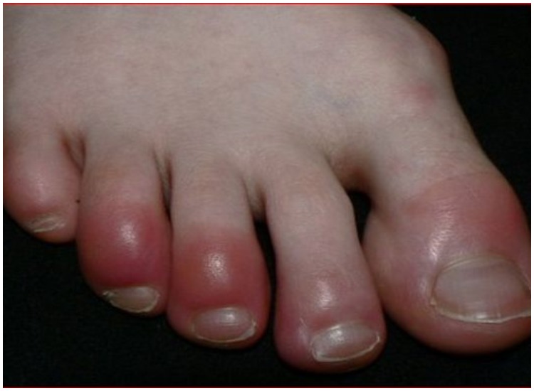 Swelling on feet Swelling on feet- India TV Hindi