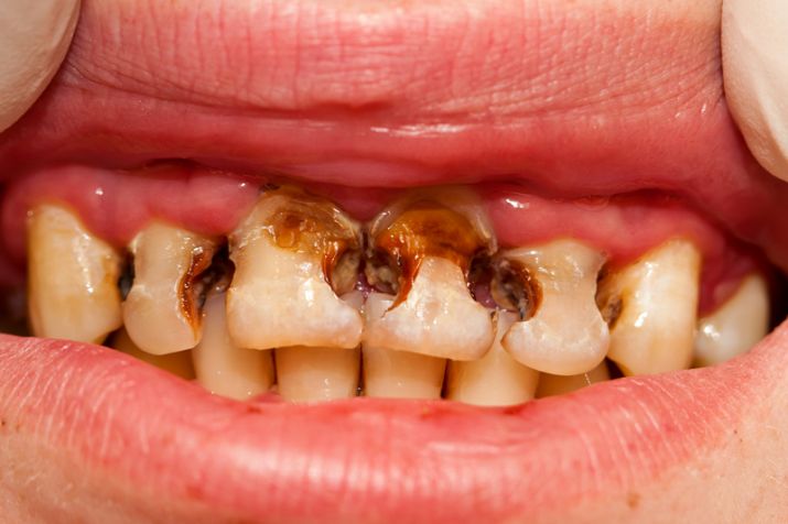 get rid of cavities with nutmeg get rid of cavities with nutmeg - India TV Hindi