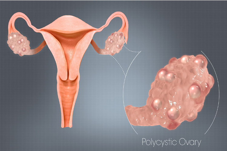 PCOS PCOS- India TV Hindi