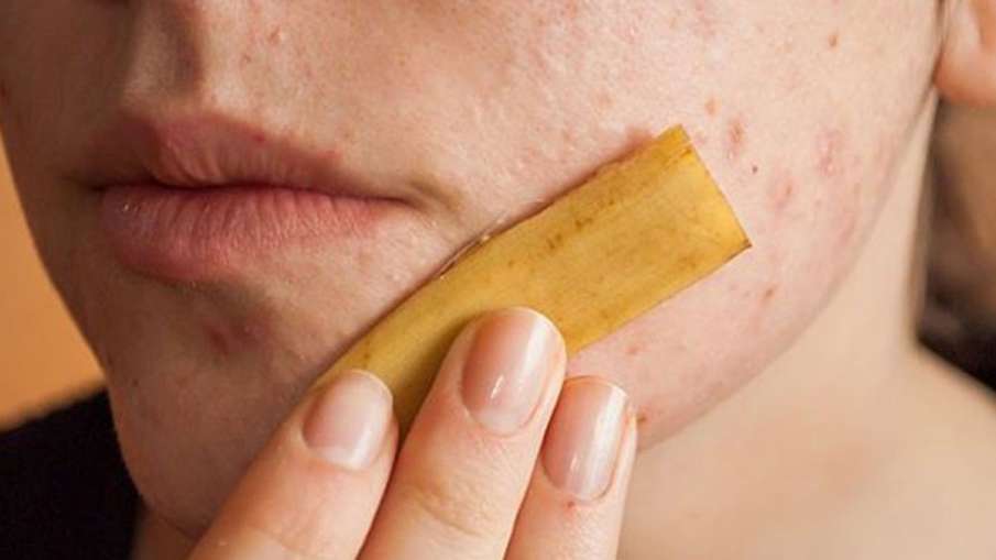 permanent Skin tags moles removal with banan peel and garlic permanent Skin tags moles removal with banan peel and garlic- India TV Hindi