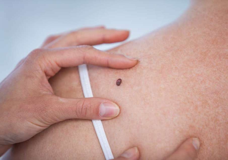 Skin cancer Skin cancer- India TV Hindi