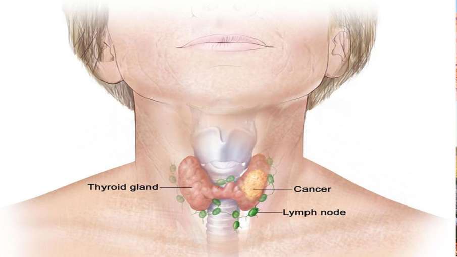 thyroid cancer thyroid cancer- India TV Hindi