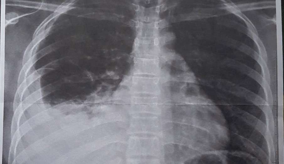 pneumonia pneumonia- India TV Hindi