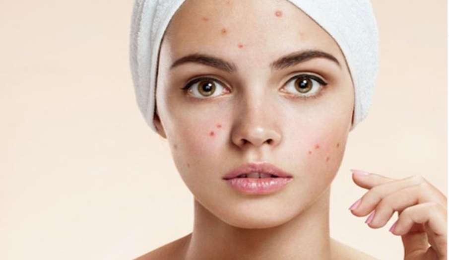 Pimple Home Remedies: मुंहासों से घबराने की जरूरत नहीं, ये टिप्स देंगे चांद सा बेदाग चेहरा Pimple Home Remedies: मुंहासों से घबराने की जरूरत नहीं, ये टिप्स देंगे चांद सा बेदाग चेहरा- India TV Hindi