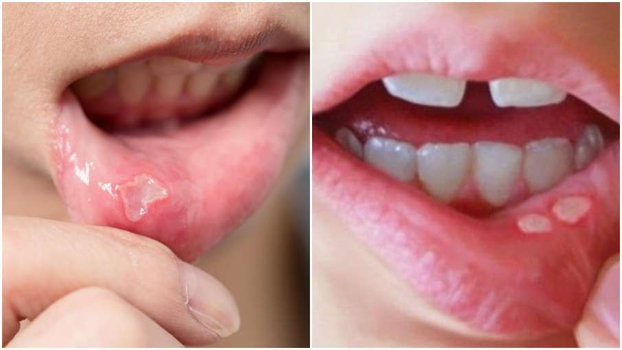 MOUTH ULCERS MOUTH ULCERS - India TV Hindi