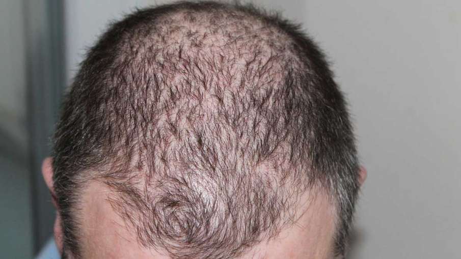 Hair Loss Complaints, Covid Patients Hair Loss, Covid Patients Hair Loss Complaints Hair Loss Complaints, Covid Patients Hair Loss, Covid Patients Hair Loss Complaints- India TV Hindi