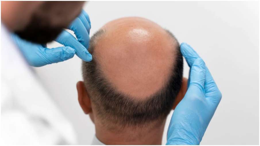 alopecia alopecia - India TV Hindi