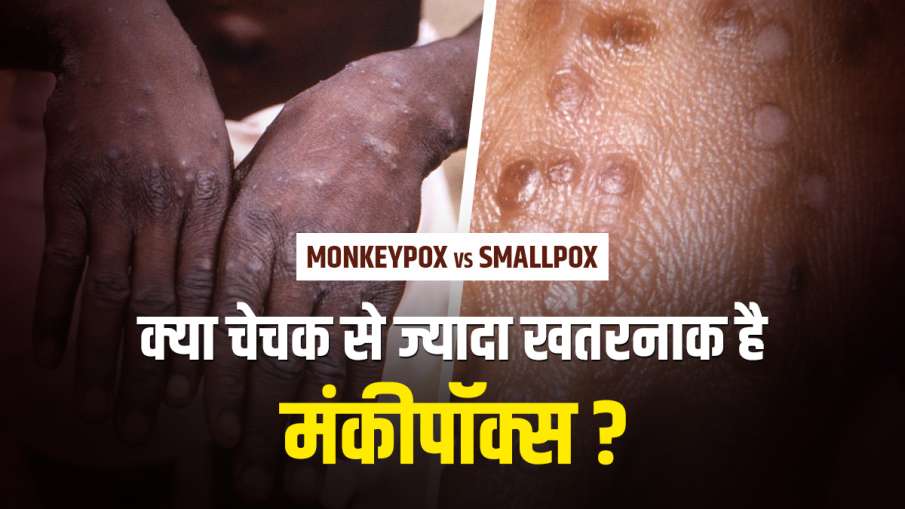 Monkeypox vs smallpox- India TV Hindi