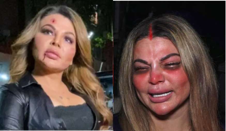 Rakhi Sawant showed her injury marks during the shooting watching this shocking video will make you - India TV Hindi