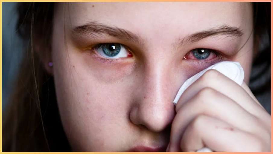 Don’t Confuse Between Pink Eye And Conjunctivitis!  Know the right thing from the expert
